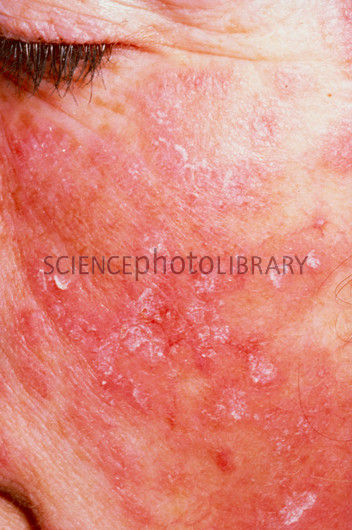 Systemic Lupus Erythematosus – SWC Healthcare